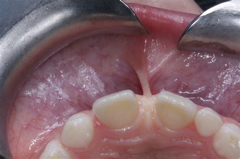 What Is A Frenectomy Does My Child Need One Orthodontic Care For