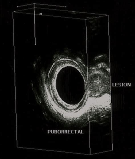 Endoanal Ultrasound Demonstrating The Location And Position Of A Download Scientific Diagram