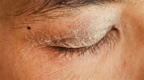 Treating Eyelid Psoriasis Medications And Home Remedies