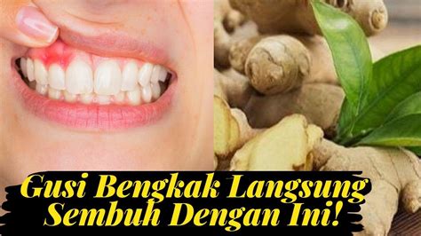 Mulai dari infeksi, gingivitis, hamil, kekurangan nutrisi, efek samping obat, hingga sisa. Cara Ampuh Atasi Gusi Bengkak dalam Sekejap - YouTube