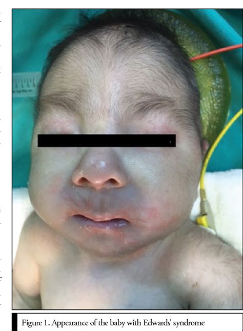 Figure From Anaesthesia Management For Edward S Syndrome Trisomy