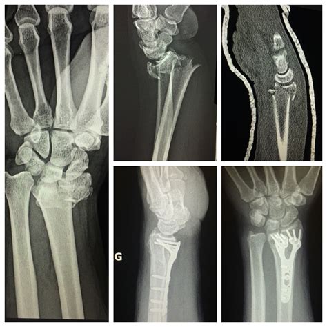 Collection Pictures Closed Fracture Of Distal End Of Left Fibula Updated