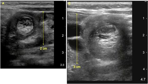 Point Of Care Ultrasound Diagnosis Of Small Bowel Small Bowel Vs