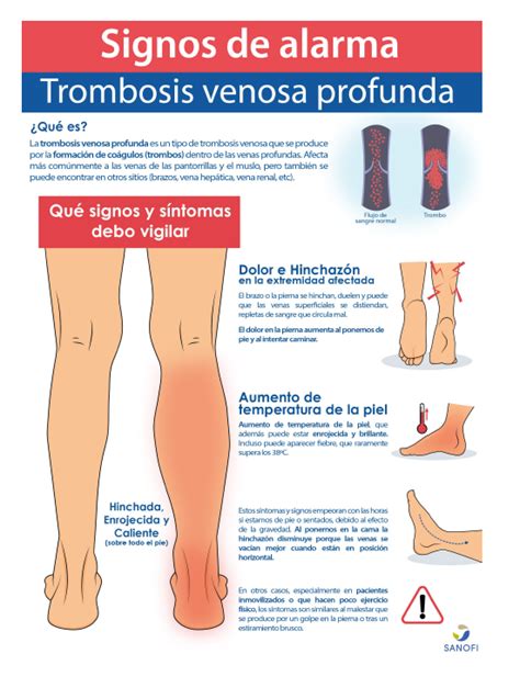 Trombosis Sintomas Causas Y Sintomas Que Es La Trombosis Venosa Porn