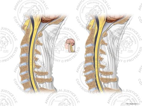 Normal Cervical Spine Vs Spondylosis No Text