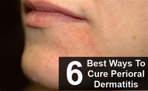 6 Greatest Methods To Remedy Perioral Dermatitis Find Out Even