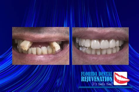Dental Implants Delray Beach Fl Florida Dental Rejuvenation