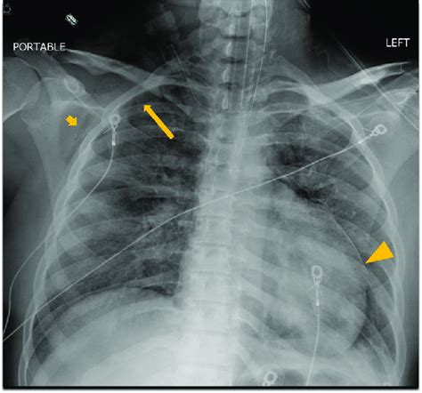 Chest Radiogram Demonstrates A Right Hemothorax Subcutaneous Emphysema