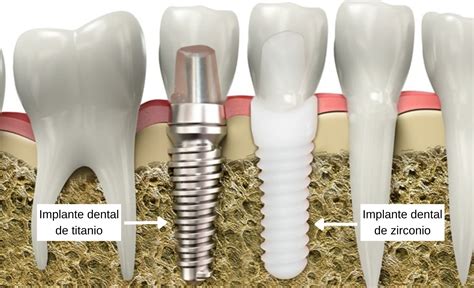Qué son los implantes dentales de zirconio