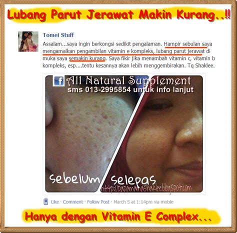Sangat penting untuk anda tahu bahawa tiada ubat sapu yang boleh dibeli di kaunter farmasi dapat menghilangkan parut jerawat berlubang. Dunia Vitaminku: Masalah Parut Jerawat Berlubang-lubang ...