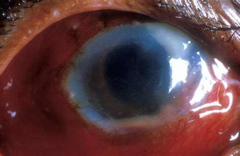 Post Operative Endophthalmitis Following Cataract Surgery Flickr