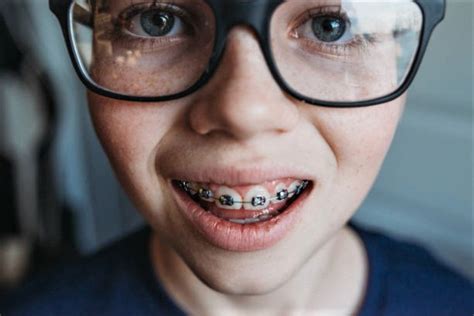 Pin By John Beeson On Guys In Braces In Orthodontics Nostril Hoop Ring Hoop Ring