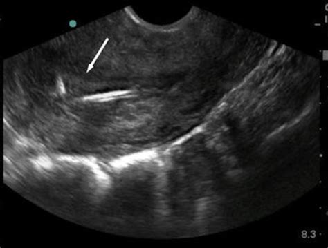Bedside Transvaginal Ultrasound In Long Axis Orientation Showing Iud