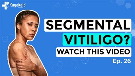 Segmental Vitiligo Watch This Video Opd Live Episode 26 Kayakalp 📞 9599794433 Youtube