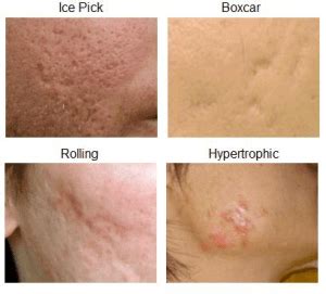 Those caused by a loss of tissue (atrophic scars), and those caused by an excess of tissue (hypertrophic scars). 8 Best Treatments for Acne Scarring