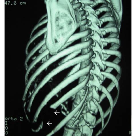 Conventional Radiograph Of The Left Lower Ribs Shows A Download