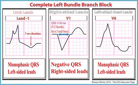 Left Bundle Branch Block Criteria Diagnosis Cardiology Grepmed