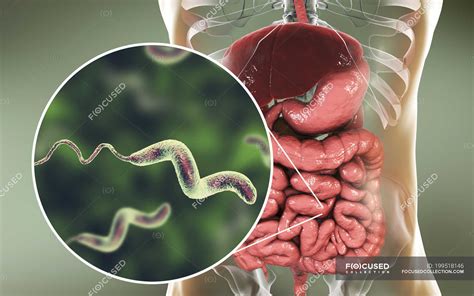 Human Intestine And Close Up Of Campylobacter Jejuni Bacteria Causing