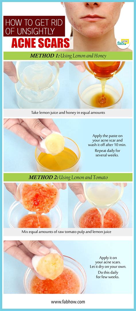 6 Home Remedies To Get Rid Of Acne Scars Fast Fab How