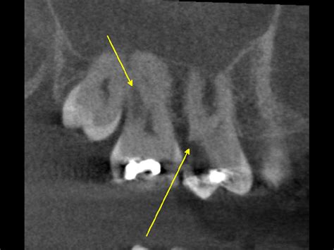 Use Of Cbct In Endodontic Treatment Planning With Impacted Wisdom Teeth