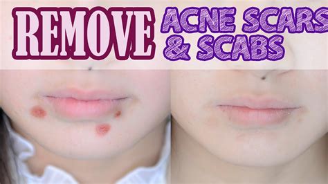 How To Get Rid Of Acne Scabs All You Need Infos