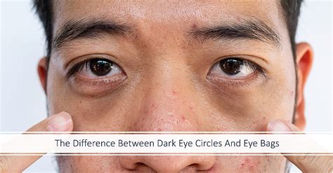 The Difference Between Dark Eye Circles And Eye Bags Dream Plastic