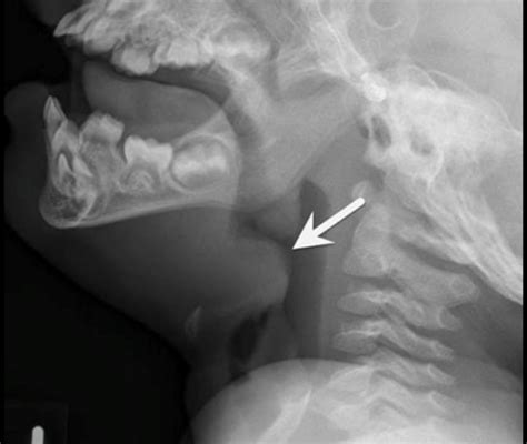 Epiglottitis Child Undergraduate Diagnostic Imaging Fundamentals