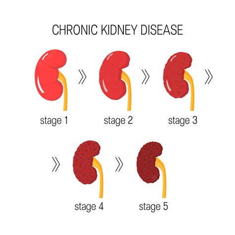 Premium Vector Chronic Kidney Disease Concept