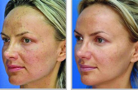 Laser Treatments Bedford Skin Clinic