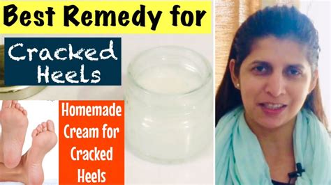 Best Natural Home Remedy For Cracked Heels Get Smooth Feet With Easy Homemade Cream In Hindi