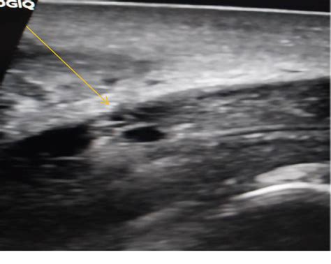Figure 1 From Penile Fracture Following Sexual Intercourse A Case Report And Literature Review
