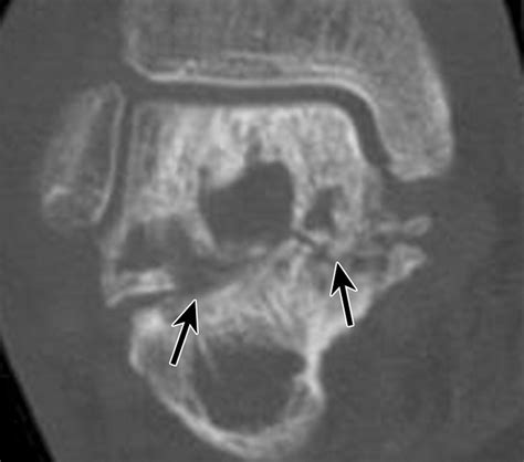 Avascular Necrosis Of The Talus A Pictorial Essay Radiographics