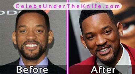 Will Smith Plastic Surgery Before After Celebsundertheknife Celebs My