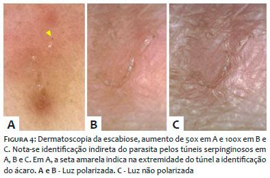 A escabiose é causada pelo ácaro sarcoptes scabiei var. Surgical And Cosmetic Dermatology - Métodos diagnósticos ...