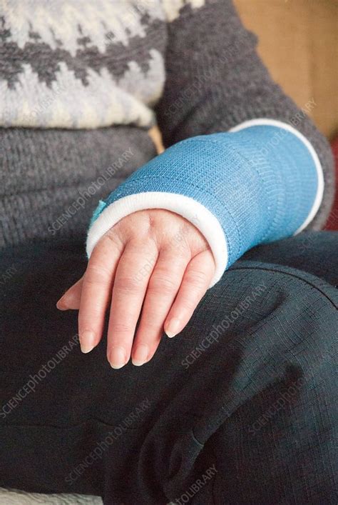 Cast On Wrist With Colles Fracture Stock Image C0360112 Science