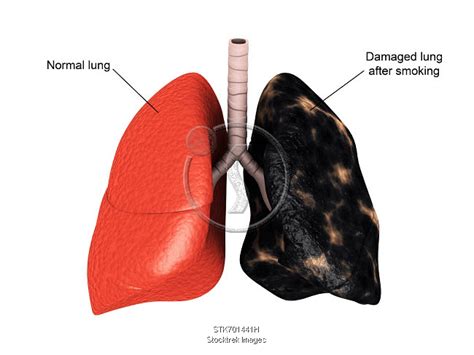 comparison of a healthy lung vs a smoker s lung stocktrek images