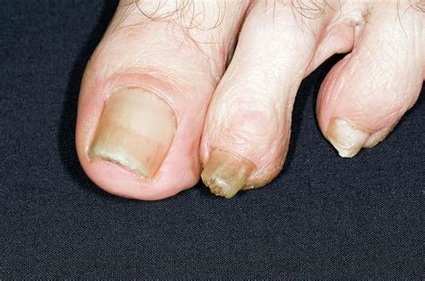 Fungal Nail Infection Photograph By Dr P Marazziscience Photo Library