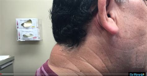 Watch Dr Pimple Popper Blast The Massive Zit On Mans Neck Video