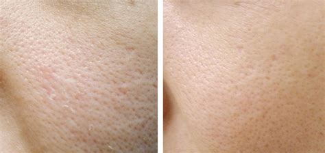 Carbon Laser Peel Our Newest Treatment For Pore Reduction