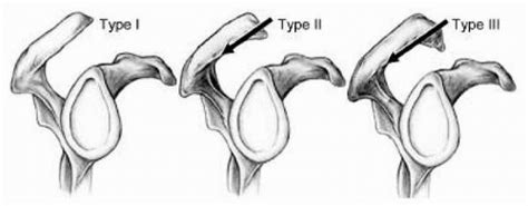 The morphology of the acromion and its relationship to rotator cuff tears. Cenník - Tommy Povajean