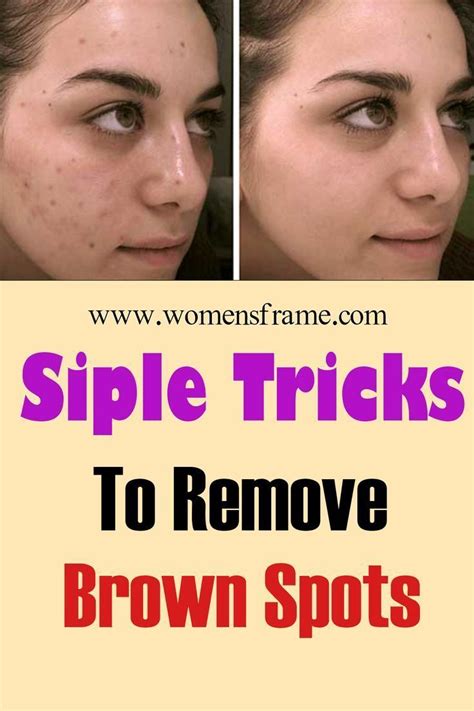 How To Get Rid Of Dark Spots And Wrinkles At Home Naturally Brown Spots On Face Dark Spots On