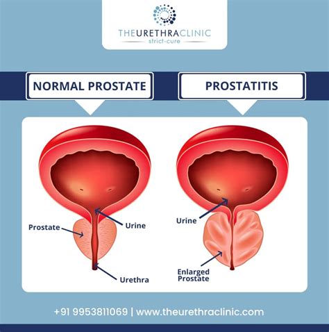 Prostatitis Symptoms Causes Diagnosis Treatment Risks