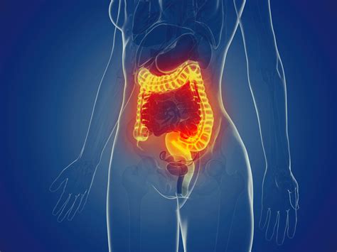 It is most often found in people aged 45 and older. Reducing Intestinal Inflammation and Colitis-Associated ...