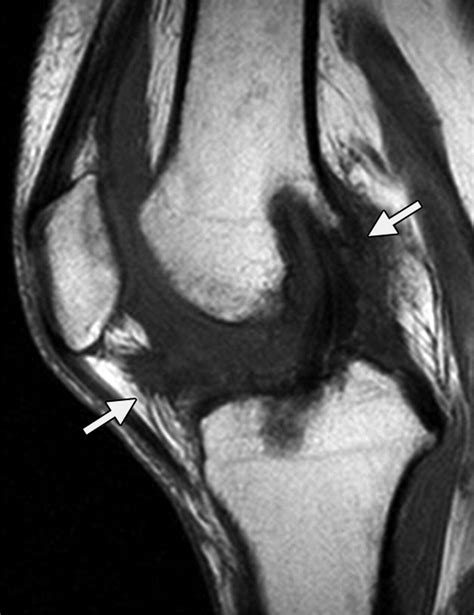 Mr Imaging Of Complications Of Anterior Cruciate Ligament Graft Reconstruction Radiographics