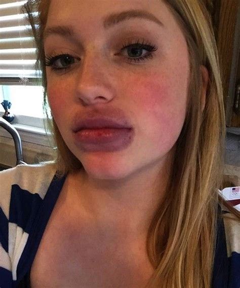 Kylie Jenner Lip Challenge Kylie Jenner Lip Challenge Kylie Jenner Lips Z Girls