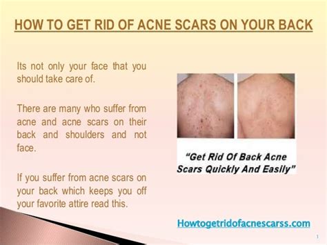 How To Get Rid Of Acne Scars At Home