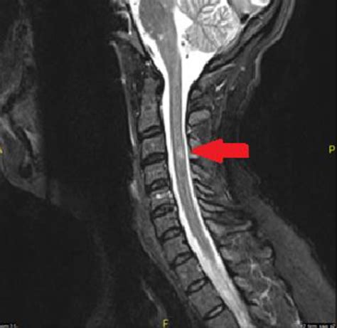 Cervical Spine Mri Ms
