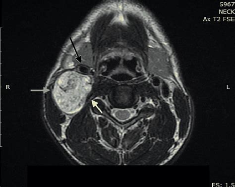 Cureus A Rare Case Of Cervical Vagus Nerve Schwannoma In An Adult Patient