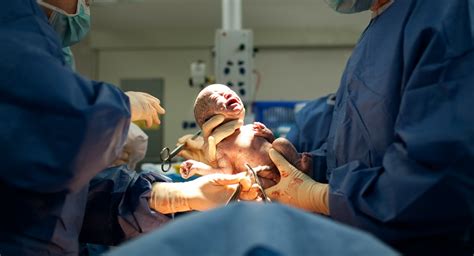 Delayed Umbilical Cord Clamping Beneficial For Infants The Clinical Advisor