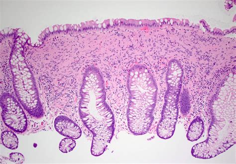 Pathology Outlines Mucosal Schwann Cell Hamartoma